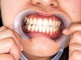 銀歯＆親知らず！！口腔咀嚼視姦と唾吐き舐め奉仕